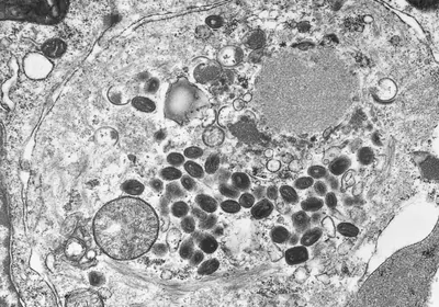 A transmission electron microscopic image of a tissue section containing variola virus particles, the pathogen responsible for causing smallpox in humans